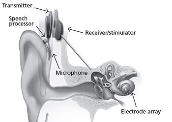 How Does a Cochlear Implant Work?