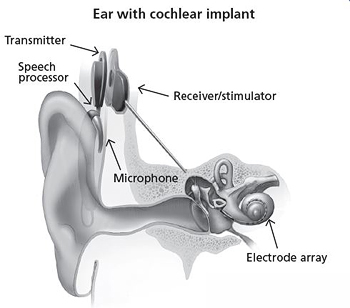 How Does a Cochlear Implant Work?